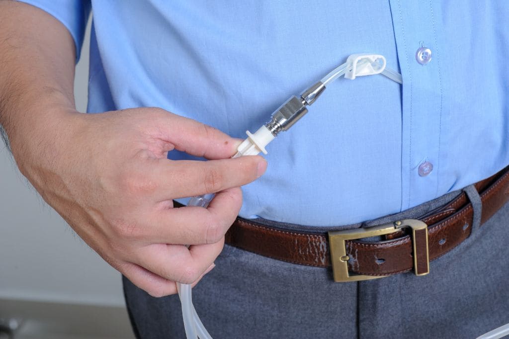 Colocación de Catéter de Diálisis Peritoneal