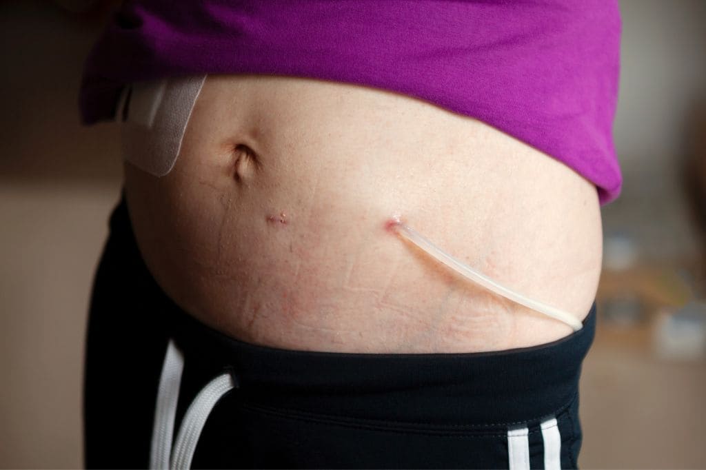 Diálisis Peritoneal