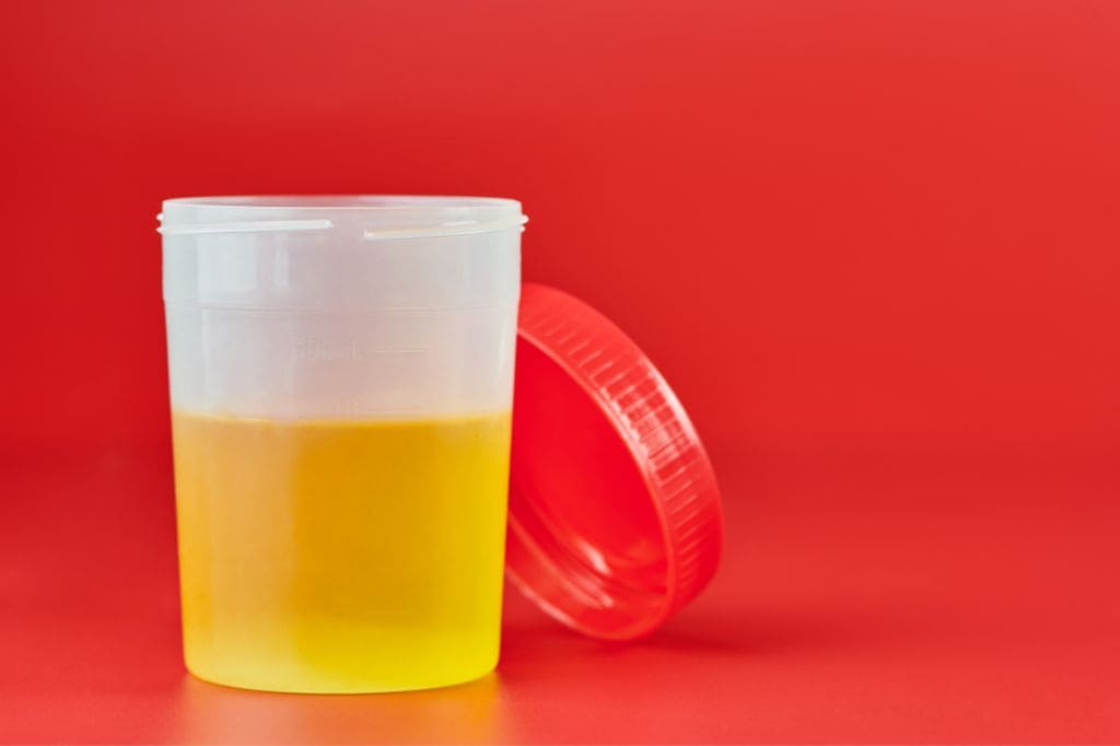 Hematuria (Sangre en la Orina)