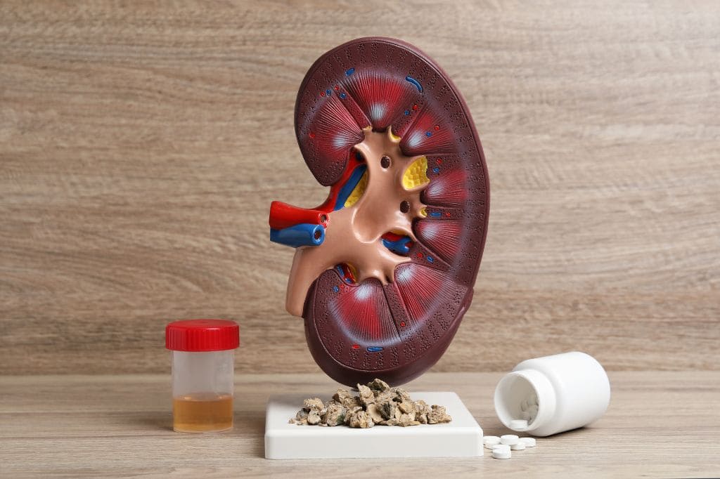 Litiasis Renal (Piedras en los Riñones)