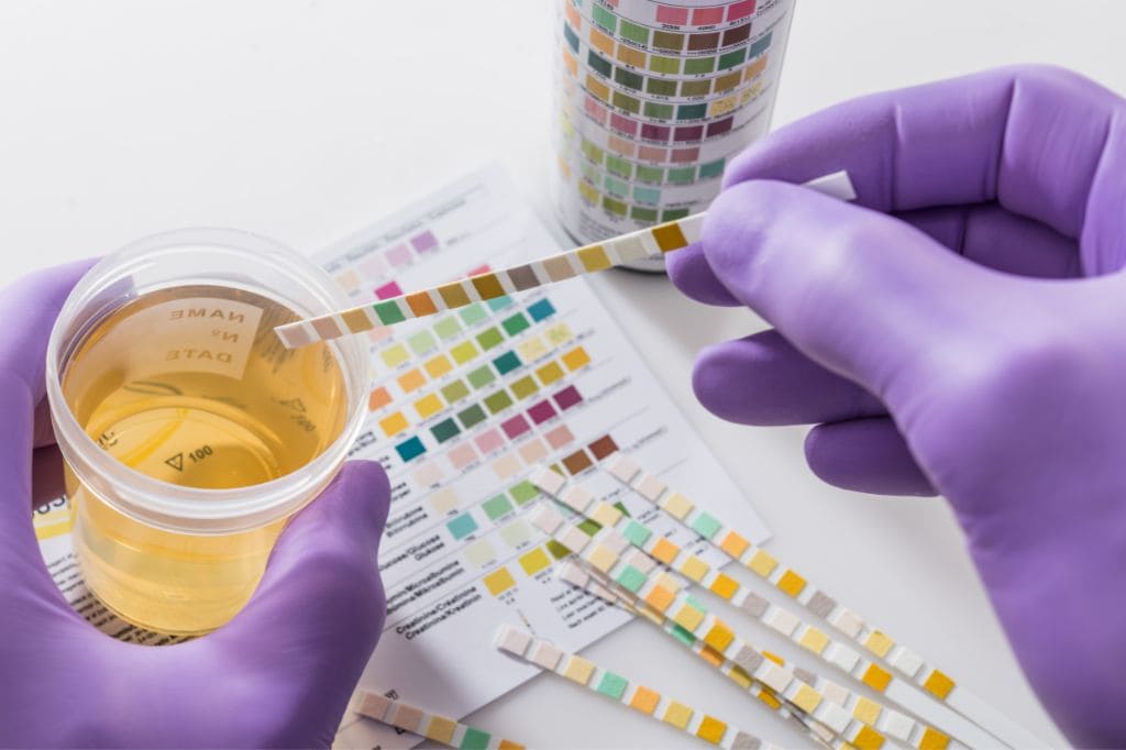 Proteinuria (Espuma en la orina)