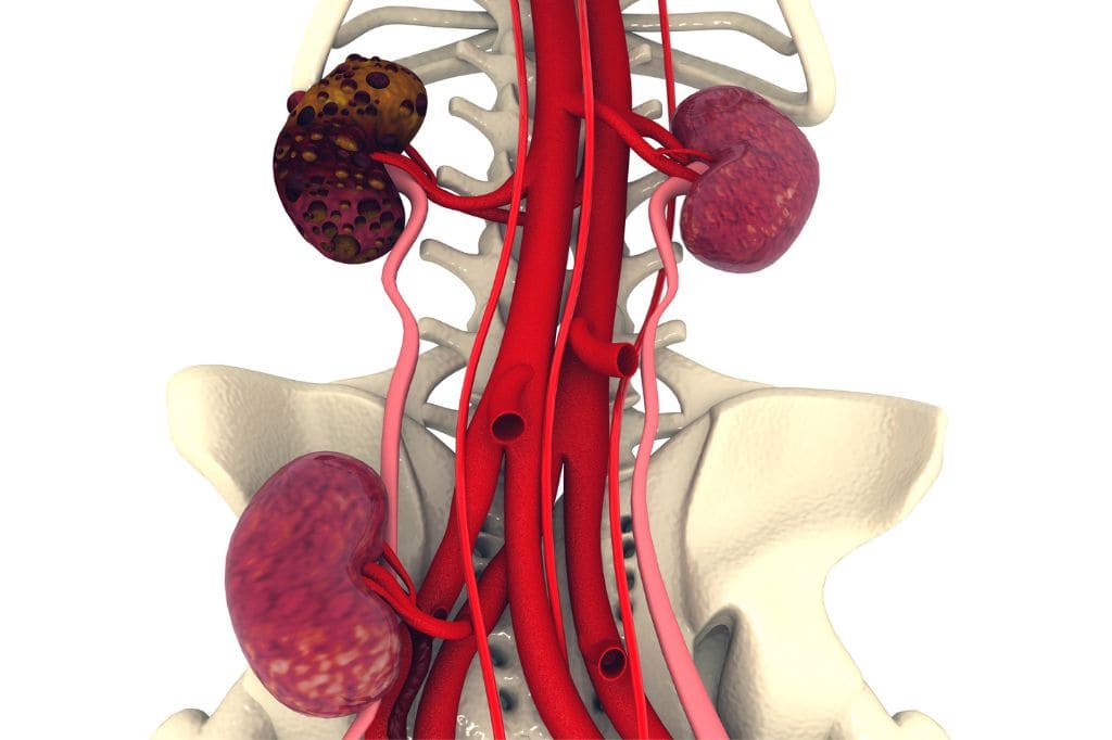 Trasplante Renal